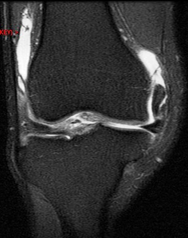 Figure 2 for case Unstable flap tear, medial meniscus